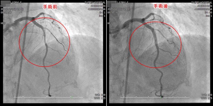 《圖說》左圖為治療前左前降支嚴重鈣化狹窄、血流受阻；右圖經血管內震波碎石術與支架置放後，血管成功擴張，血流明顯改善。〈臺北醫院提供〉