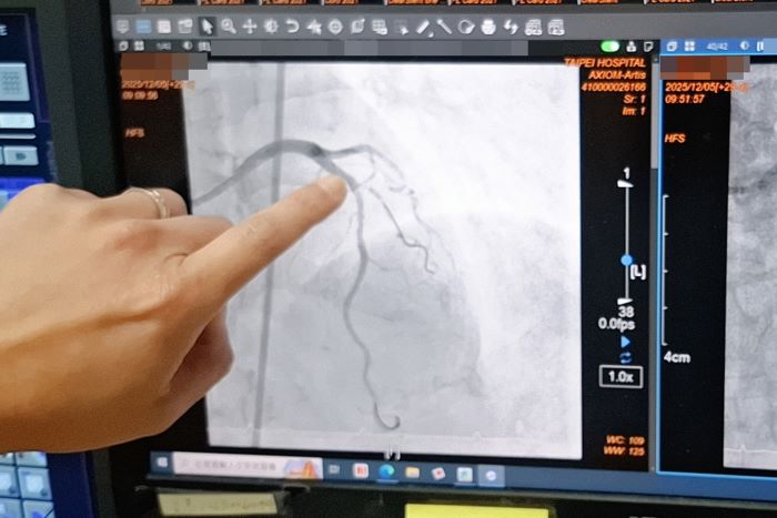 《圖說》自引進「血管內震波碎石術」，臺北醫院心臟內科已順利完成超過17例高難度冠狀動脈鈣化導管手術。〈臺北醫院提供〉